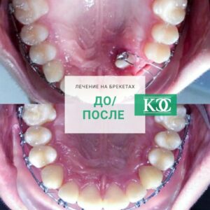 До/после До/после