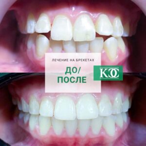 До/после До/после