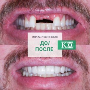 До/после До/после