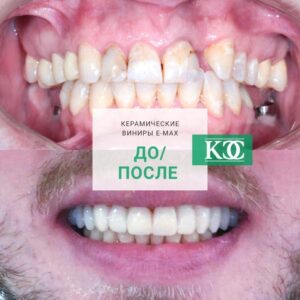 До/после До/после