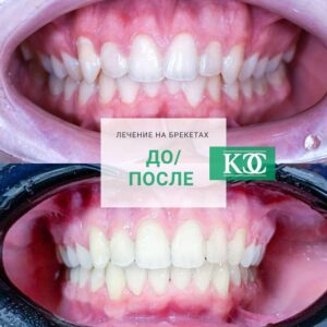 До/после До/после