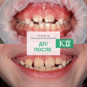 До/после До/после