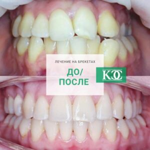 До/после До/после