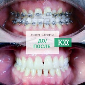 До/после До/после