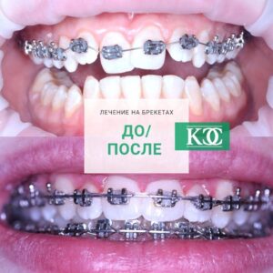 До/после До/после