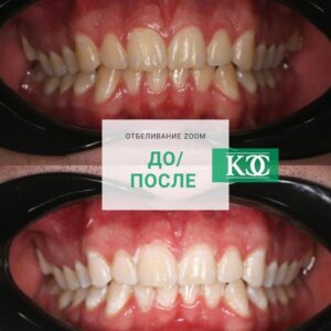 До/после До/после