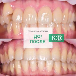 До/после До/после