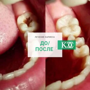 До/после До/после