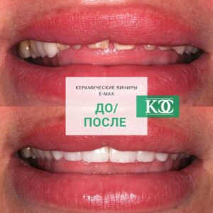До/после До/после