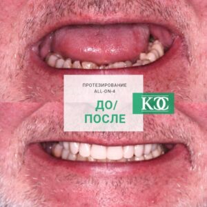 До/после До/после