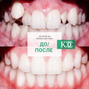 До/после До/после