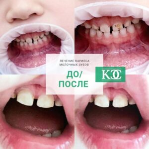 До/после До/после
