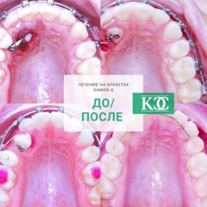 До/после До/после