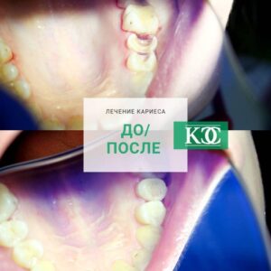 До/после До/после