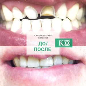 До/после До/после