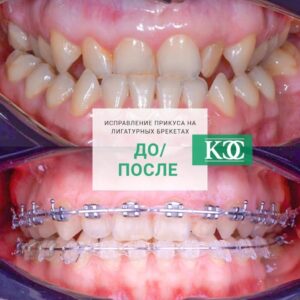 До/после До/после
