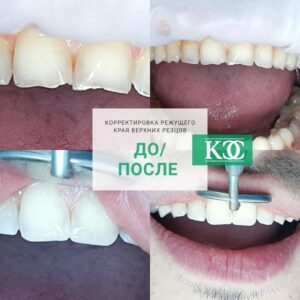 До/после До/после