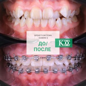 До/после До/после