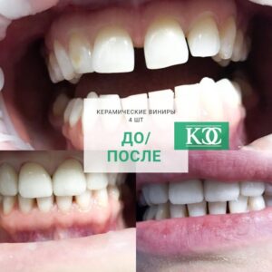 До/после До/после