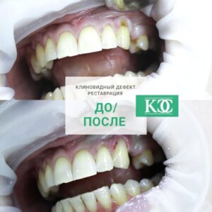 До/после До/после