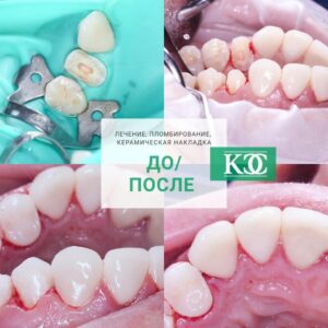 До/после До/после