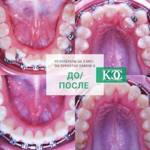 До/после До/после
