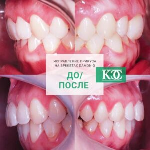 До/после До/после