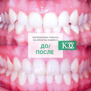До/после До/после