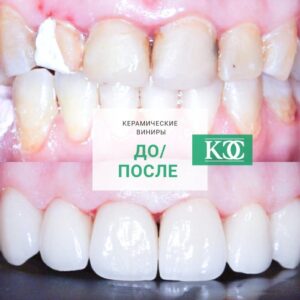 До/после До/после