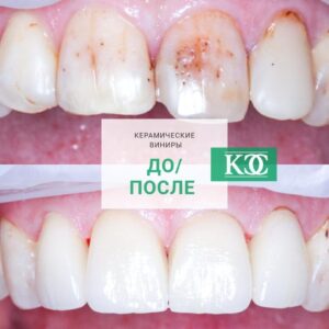 До/после До/после