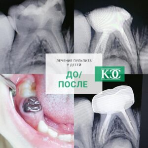 До/после До/после
