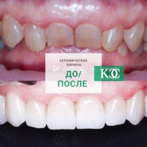 До/после До/после