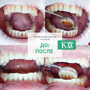 До/после До/после