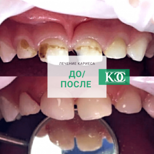 До/после До/после