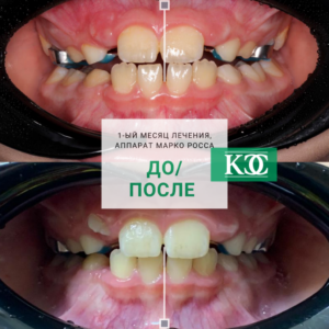 До/после До/после