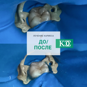 До/после До/после